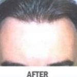 Hair Transplant Before & After Patient #2041