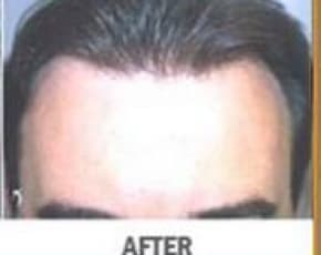 Hair Transplant Before & After Patient #2041