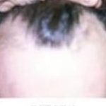 Hair Transplant Before & After Patient #2041