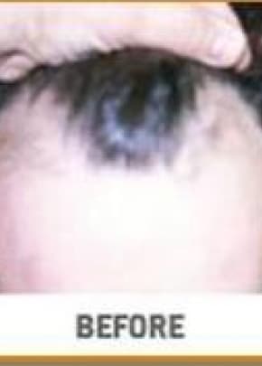 Hair Transplant Before & After Patient #2041