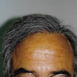 Hair Transplant Before & After Patient #2040
