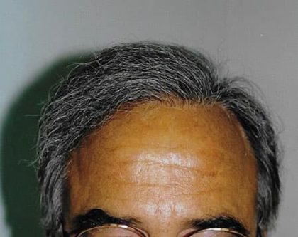 Hair Transplant Before & After Patient #2040