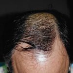 Hair Transplant Before & After Patient #2040