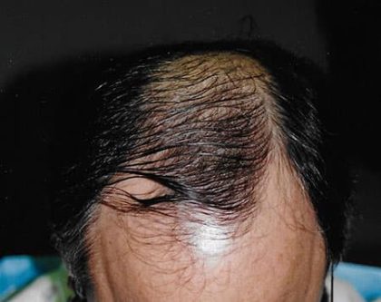 Hair Transplant Before & After Patient #2040
