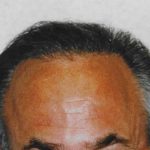 Hair Transplant Before & After Patient #2039
