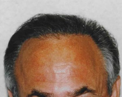 Hair Transplant Before & After Patient #2039