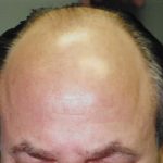 Hair Transplant Before & After Patient #2039