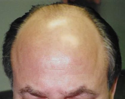 Hair Transplant Before & After Patient #2039