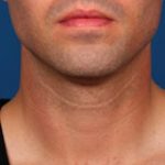 Kybella Before & After Patient #2246