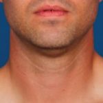 Kybella Before & After Patient #2246