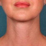 Kybella Before & After Patient #2245