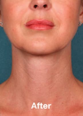 Kybella Before & After Patient #2245