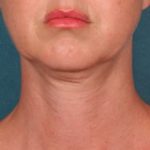 Kybella Before & After Patient #2245