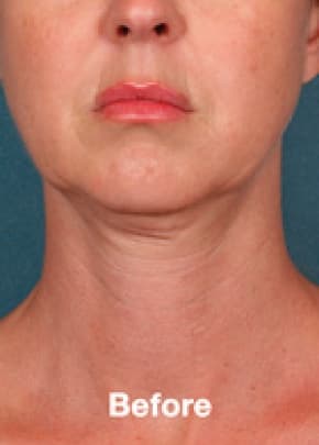 Kybella Before & After Patient #2245