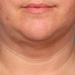Kybella Before & After Patient #2244