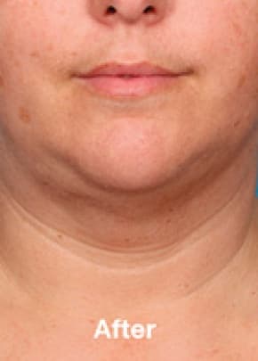 Kybella Before & After Patient #2244