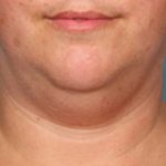 Kybella Before & After Patient #2244