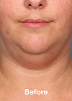 Kybella Before & After Patient #2244