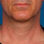 Kybella Before & After Patient #2243