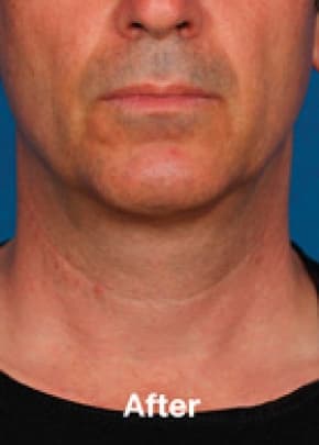 Kybella Before & After Patient #2243
