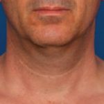 Kybella Before & After Patient #2243