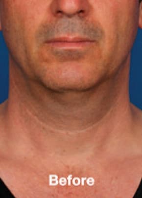 Kybella Before & After Patient #2243
