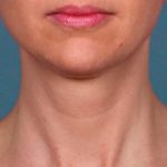 Kybella Before & After Patient #2242
