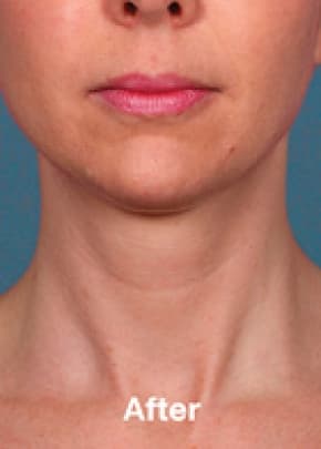 Kybella Before & After Patient #2242