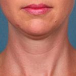 Kybella Before & After Patient #2242