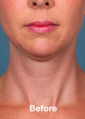 Kybella Before & After Patient #2242