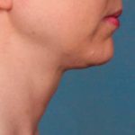 Kybella Before & After Patient #2241