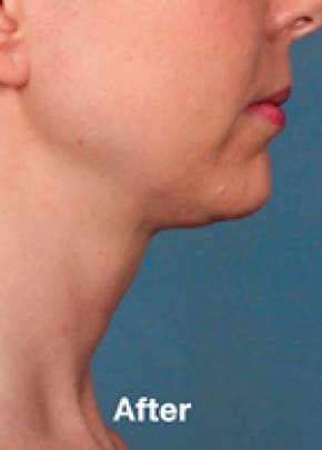 Kybella Before & After Patient #2241