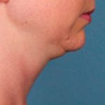 Kybella Before & After Patient #2241