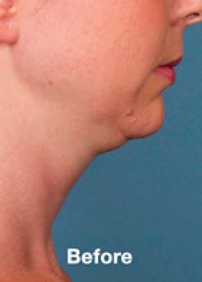 Kybella Before & After Patient #2241