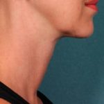 Kybella Before & After Patient #2240