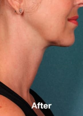 Kybella Before & After Patient #2240