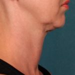 Kybella Before & After Patient #2240