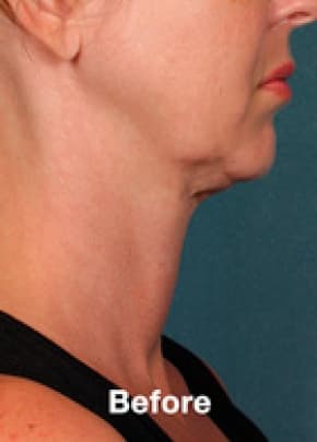 Kybella Before & After Patient #2240