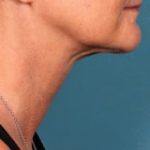 Kybella Before & After Patient #2239