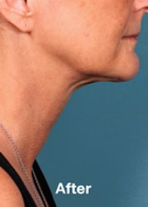 Kybella Before & After Patient #2239