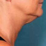 Kybella Before & After Patient #2239