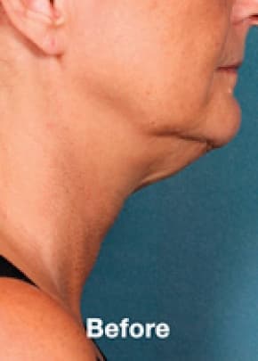Kybella Before & After Patient #2239
