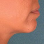 Kybella Before & After Patient #2238