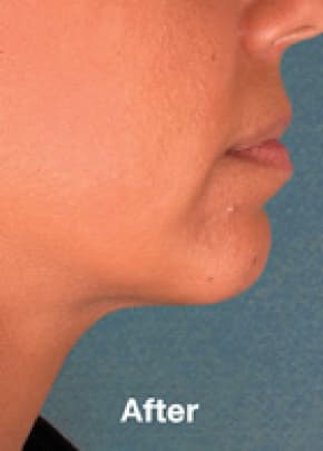 Kybella Before & After Patient #2238