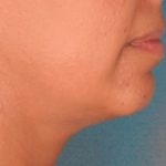 Kybella Before & After Patient #2238
