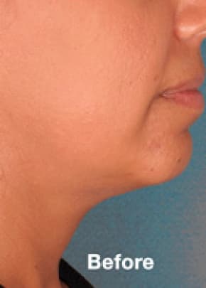 Kybella Before & After Patient #2238