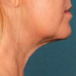 Kybella Before & After Patient #2217