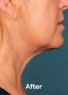 Kybella Before & After Patient #2217