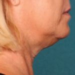 Kybella Before & After Patient #2217
