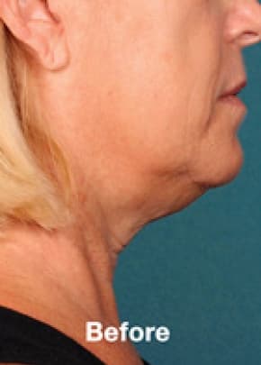 Kybella Before & After Patient #2217